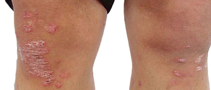Psoriāze ir nepatīkama ādas slimība, kurai nepieciešama ārstēšana ar Keraderm krēmu