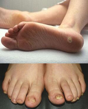 Mikozes izpausmes uz pēdu ādas un nagiem
