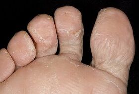 Pēdu āda ar sēnīšu infekciju