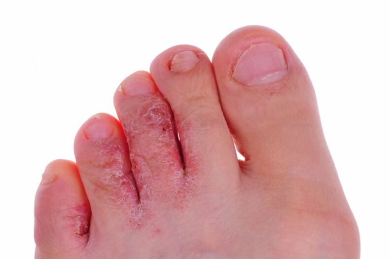 Rubrofitozes simptomi - plaisas un zvīņas uz kāju ādas