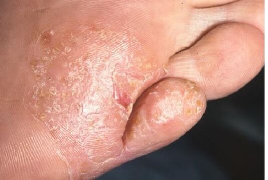 Sēnīšu infekcijas izpausmes uz pēdas ādas